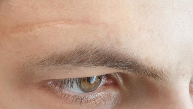 Do you find scars gross?