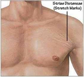 Am I the only finds who finds stretch marks hot ??