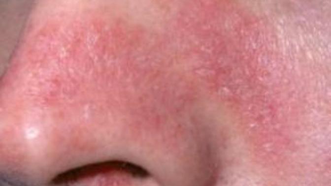 Help! Red skin that appears dry around my nose and around my mouth/chin will NOT go away?