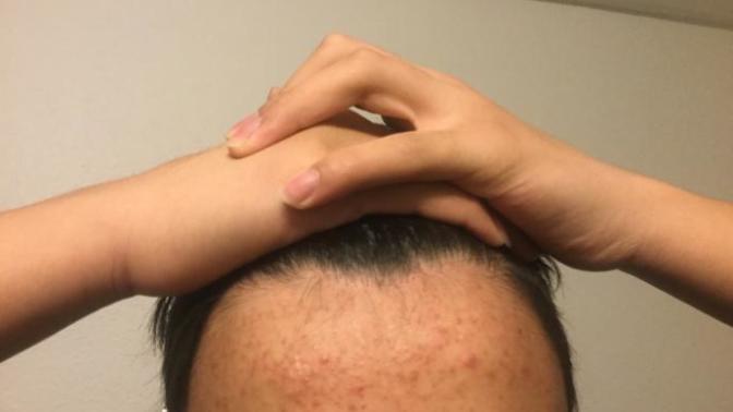 Pimples or Acne?