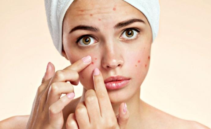 Would you date someone with acne?