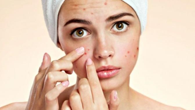 Would you date someone with acne?