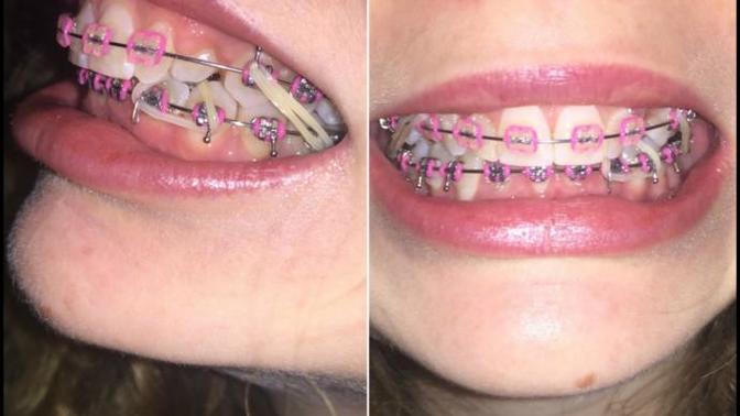 Girls, Would my braces and dental work put people off kissing me?