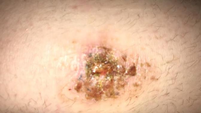 Is this healing correctly?