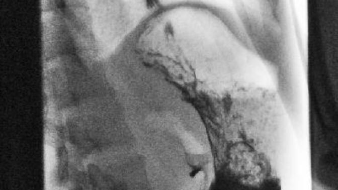 What does the barium swallow show?