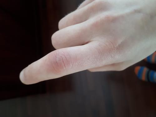 Why has my finger been red and swollen for the past 2 weeks?