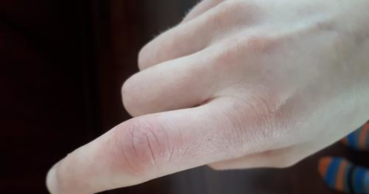 Why has my finger been red and swollen for the past 2 weeks? GirlsAskGuys