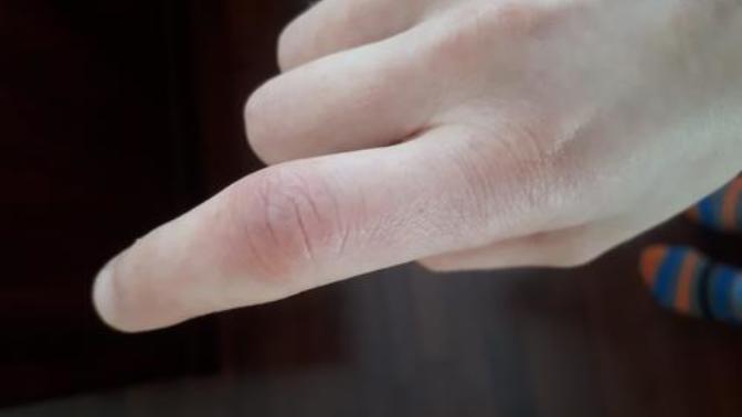 Why has my finger been red and swollen for the past 2 weeks?