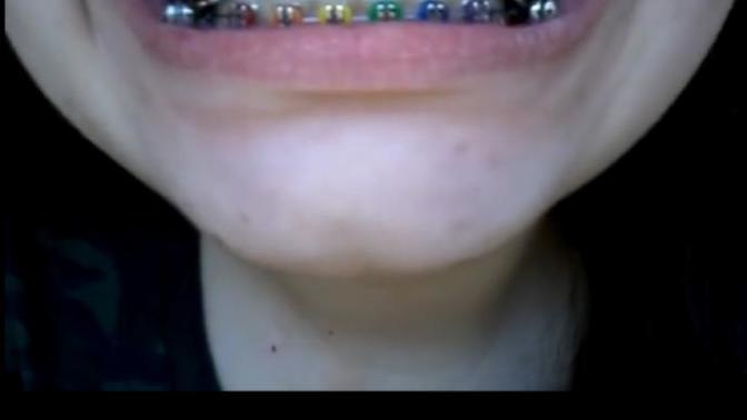 Girls, I had the colours put on my braces to make me less self conscious, what do you think?