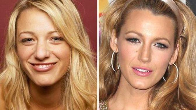 Would you judge a girl for getting a nose job?