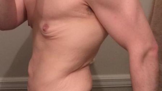 Dating and Loose Skin After Weight Loss (Pictures Included)?