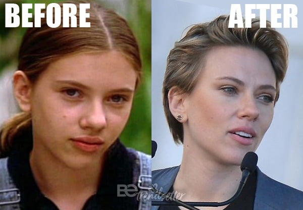scarlett johansson nose surgery
