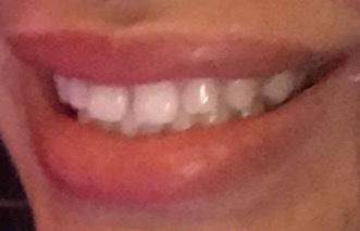Should I get braces?
