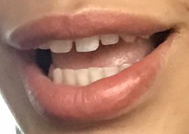Should I get braces?