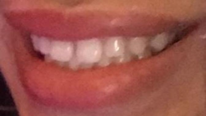Should I get braces?