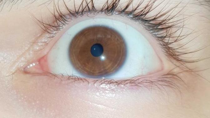 What is that blue circle around my eye?