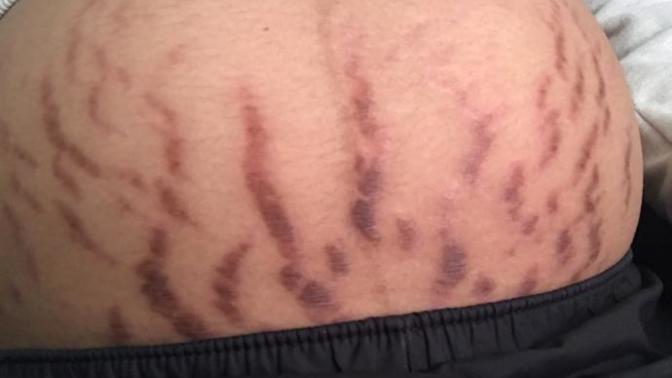 How do you decrease the redness of new stretch marks?