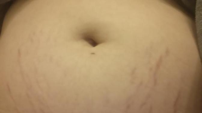 How to get rid of these stretch marks?
