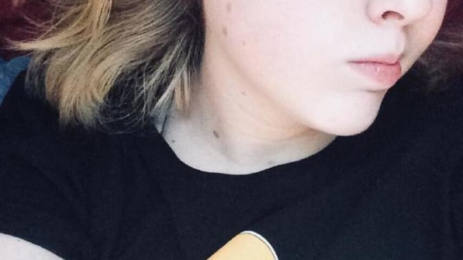 Do moles make me unattractive, or a “deal breaker”?