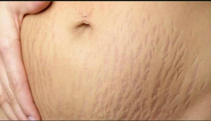 Why do girls have stretch marks more than boys??