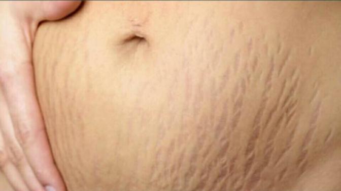 Why do girls have stretch marks more than boys?