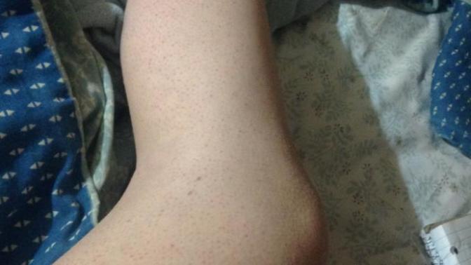 Red bumps always all over legs?