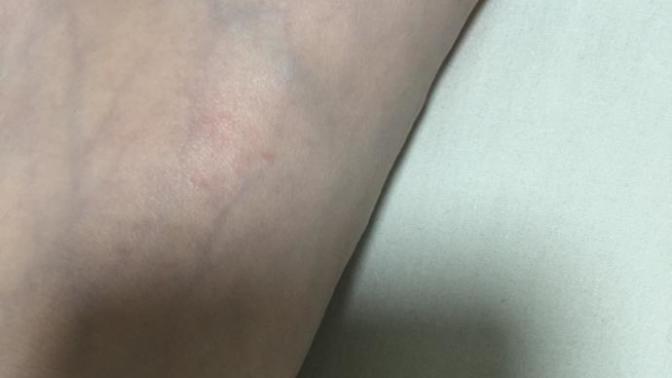 Why is my feet so veiny?