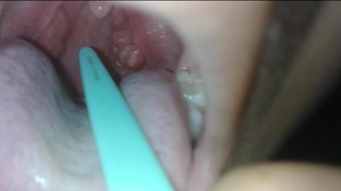 Warning pictures may be a little gross but does it look like I have strep throat?