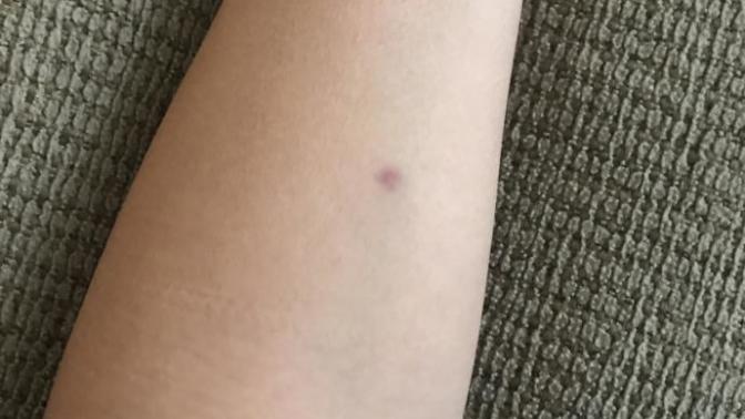 I’m a little worried I got a tb test for work and there is not bump it’s just flat. I don’t know if this is a good or bad sign or if it’s a bruise?