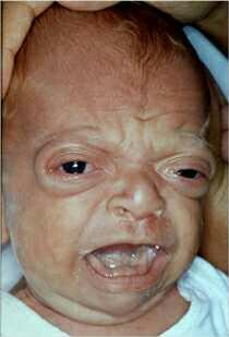 If you found out your child was special needs and look like This on night upon receiving child,would you or would you not keep the child??