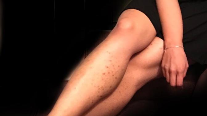 Would these dark scars/spots on legs turn you off/bother you?