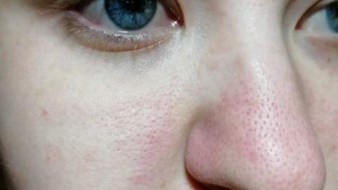How do I remove blackheads?