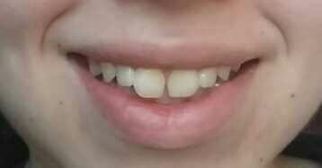 Would you mind a tooth gap like this on a girl??