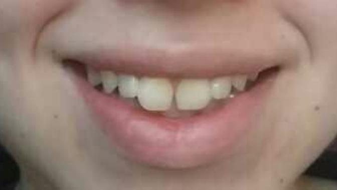 Would you mind a tooth gap like this on a girl?