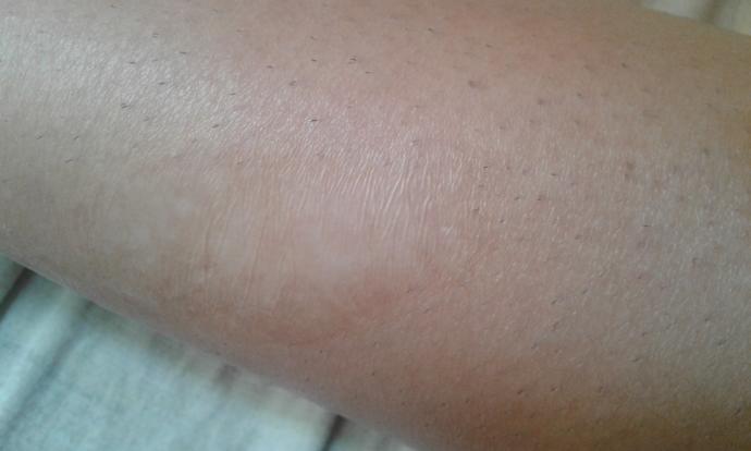 Is this a 2nd or 3rd degree burn?