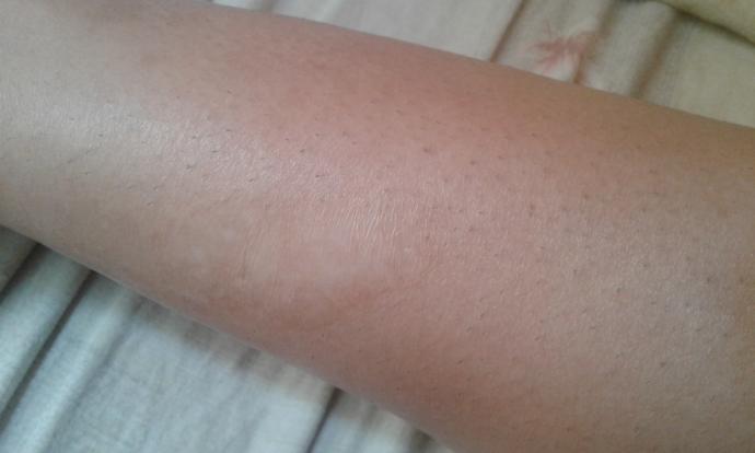 Is this a 2nd or 3rd degree burn?