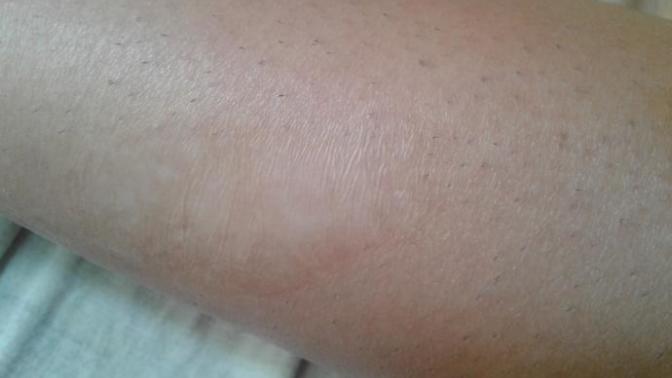 Is this a 2nd or 3rd degree burn?