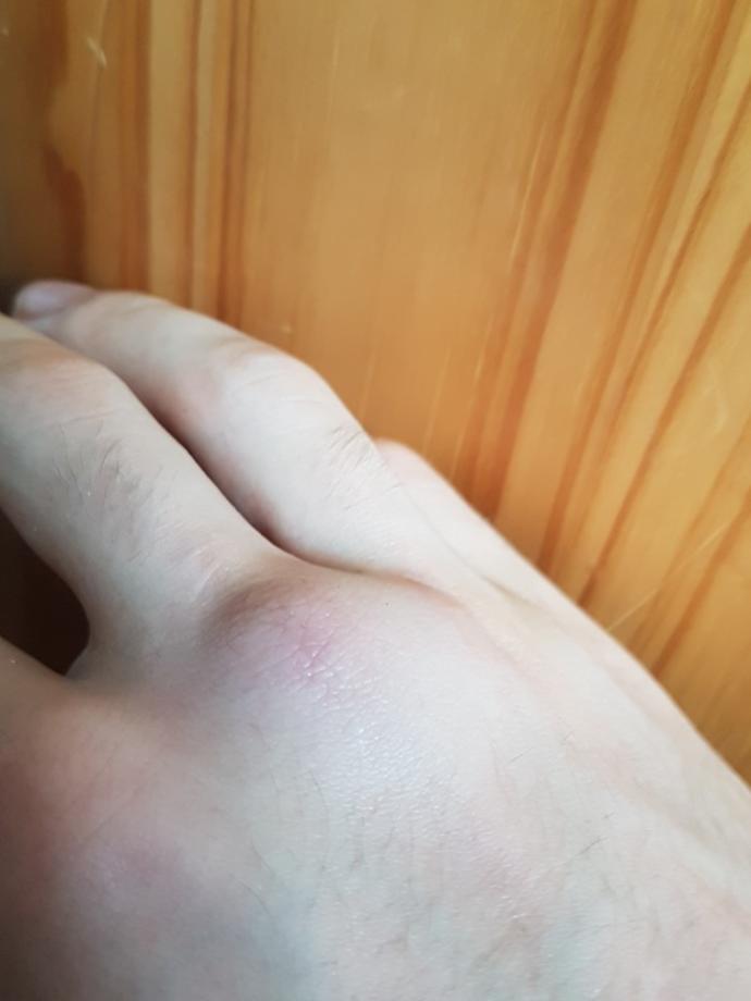 My knuckle is swollen after hitting something hard. Is it ok just to leave it??