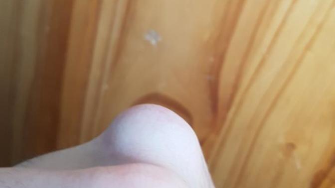 My knuckle is swollen after hitting something hard. Is it ok just to leave it?