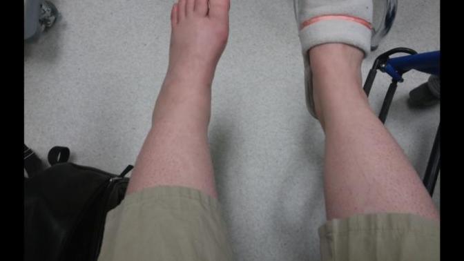 How bad does my ankle look?