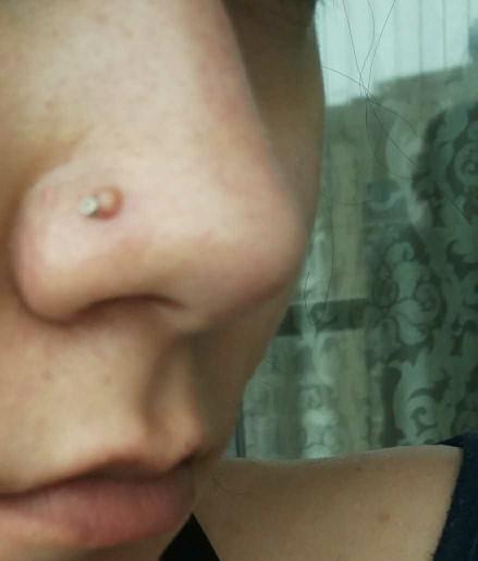 My nose piercing developed a HUGE bump what do I do?