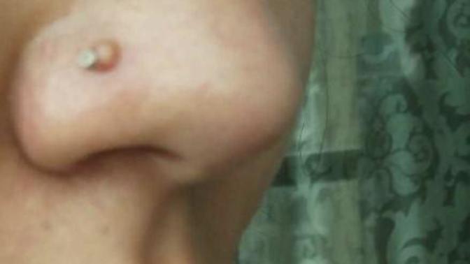 My nose piercing developed a HUGE bump what do I do?