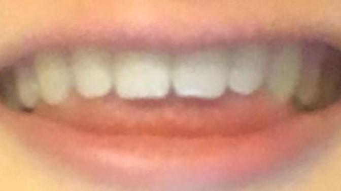 Dislike my small teeth, do you think I should get veneers?