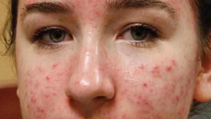 Would acne/scars bother you when looking for a partner?