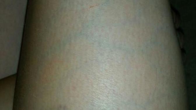 Woke up with veins all over my leg. What could've caused this?