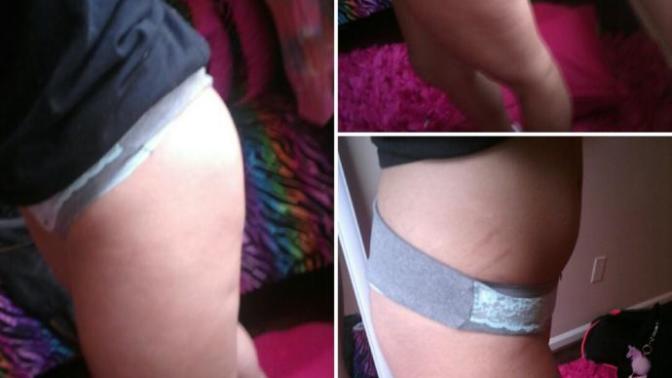 I have brown stretch marks on my hips (bottom right pic) and I have some cellulite on my legs do my legs look good, bad, or okay?