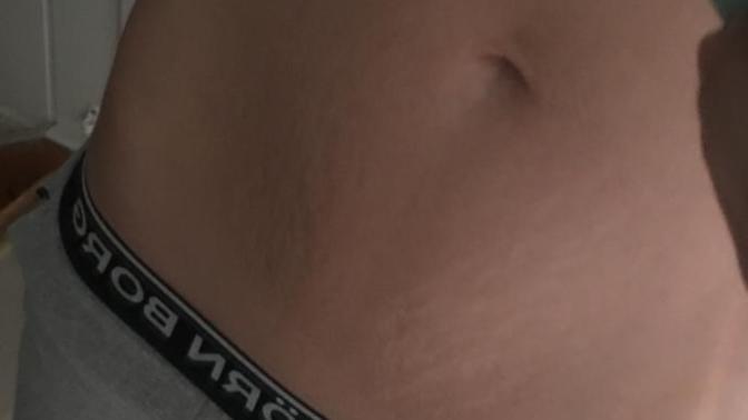 Stretchmarks. Can girls help with advice? Guys do You find it very unattractive?