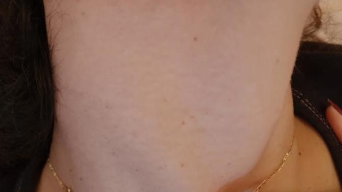 Are skin tags a turn off?