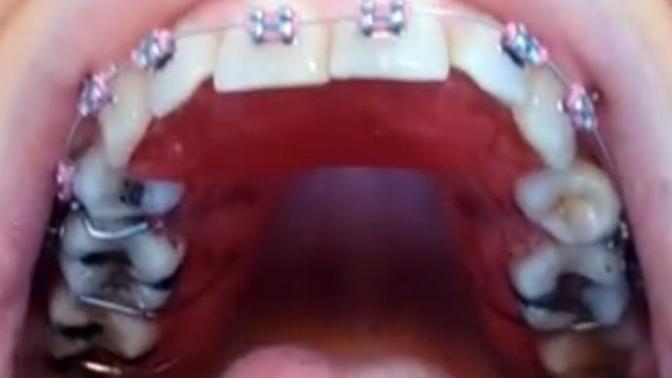 Girls, Do my braces/dental work look disgusting?