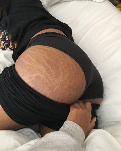 Do you mind if the girl you are dating has stretch marks on her butt? 